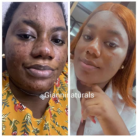 Client skincare transformation