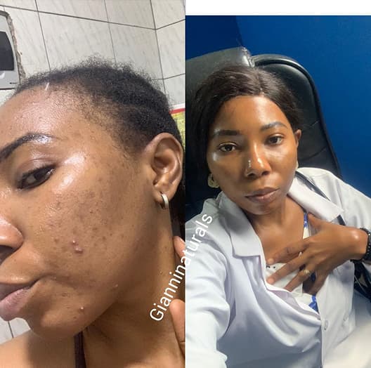 Client skincare transformation