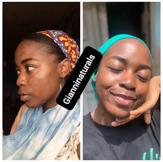 Client skincare transformation